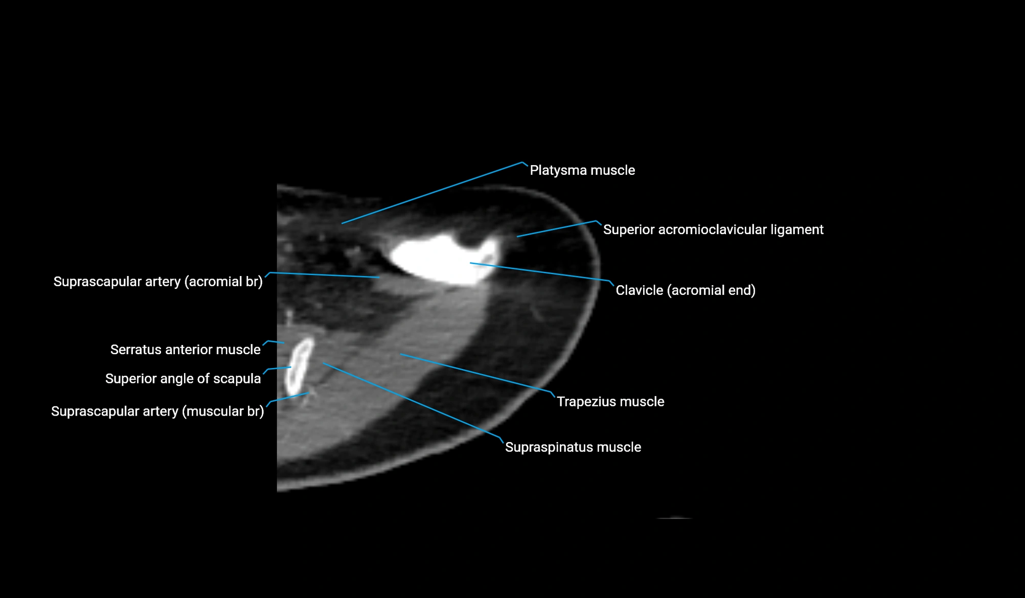 CT upper arm axial  cross sectional anatomy labelled radiology image -00054.webp